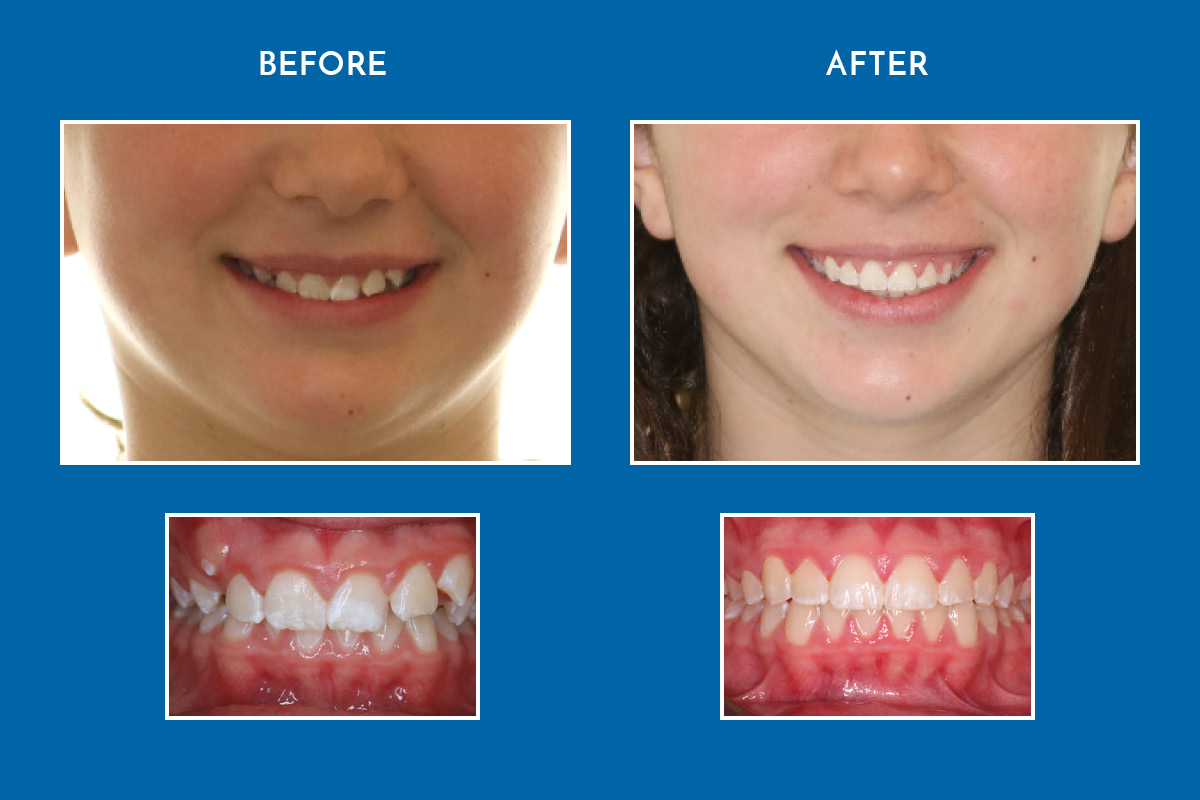 Orthodontics on Queen Invisalign & Braces in The Beach, Toronto